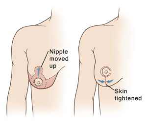 Schéma d'une opération de lifting des seins