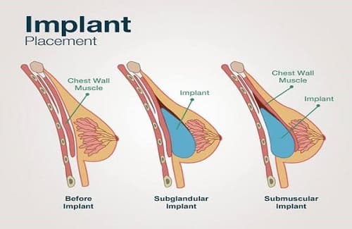Shema implantacije prsnih vsadkov pod in nad mišico