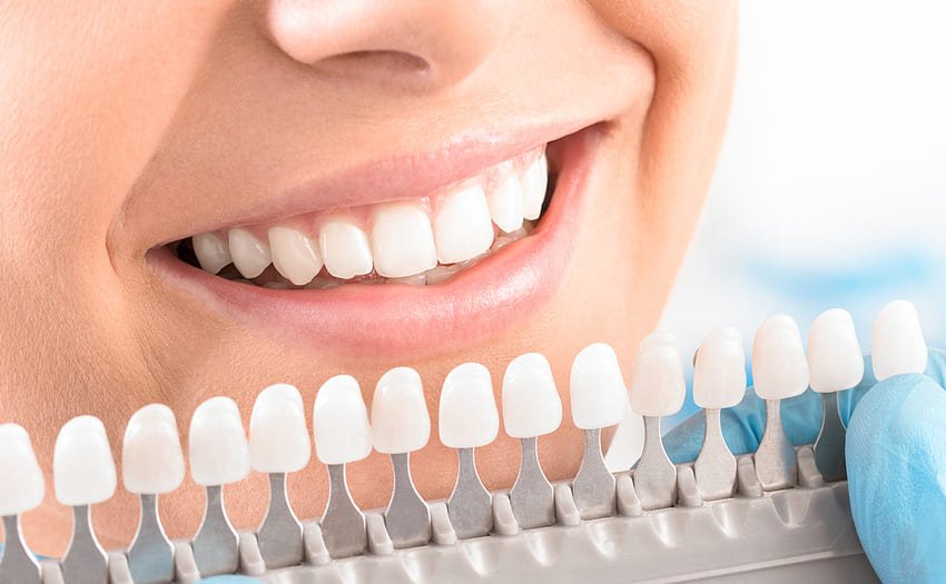 Choix de la teinte des dents