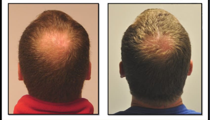 Photo avant et après une greffe DHI