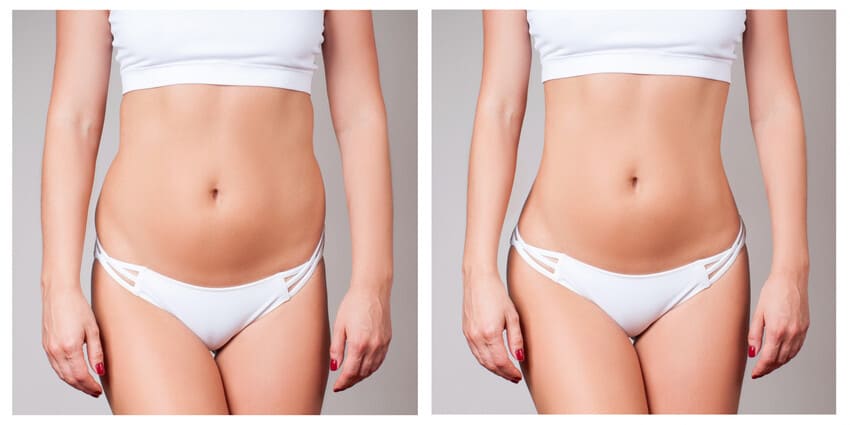 Simulation avant et après la liposuccion du ventre