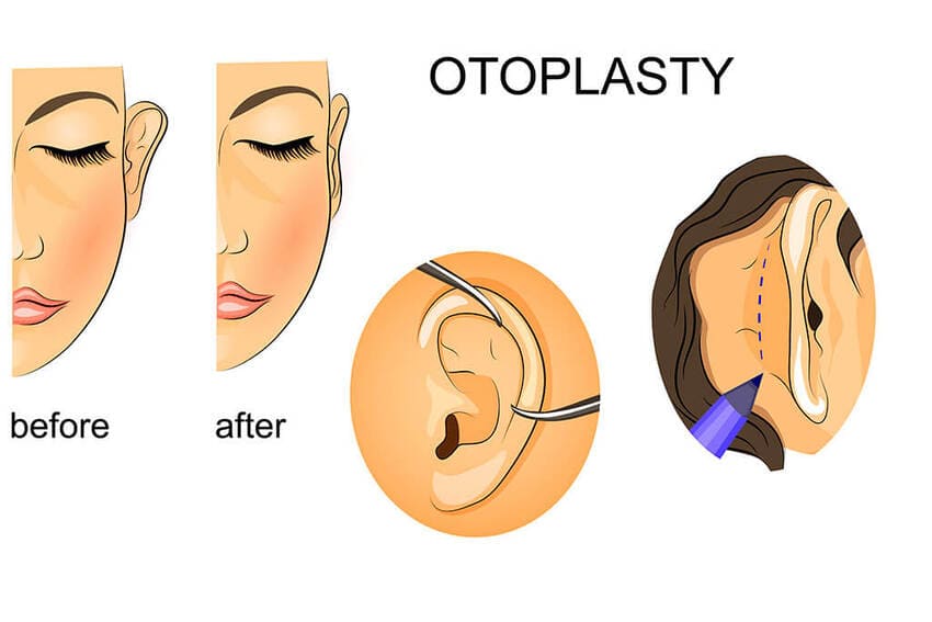 Schéma d'illustration sur l'otoplastie