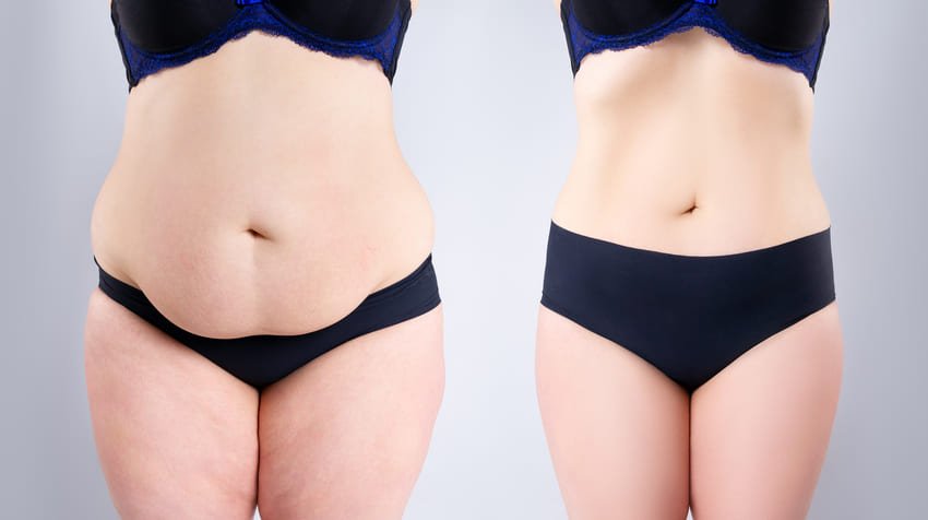Simulation avant et après une liposuccion du ventre
