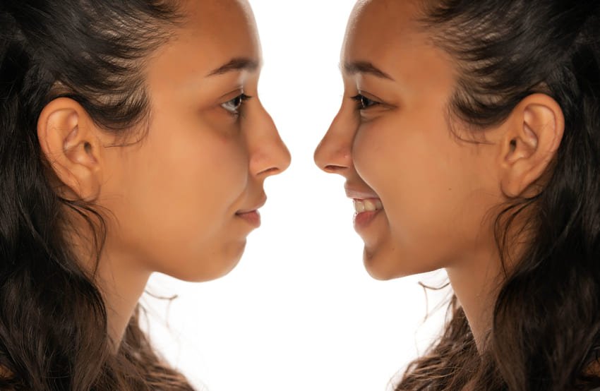Photo avant et après d'une rhinoplastie