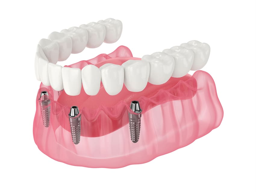 Dentition qui repose sur 4 piliers