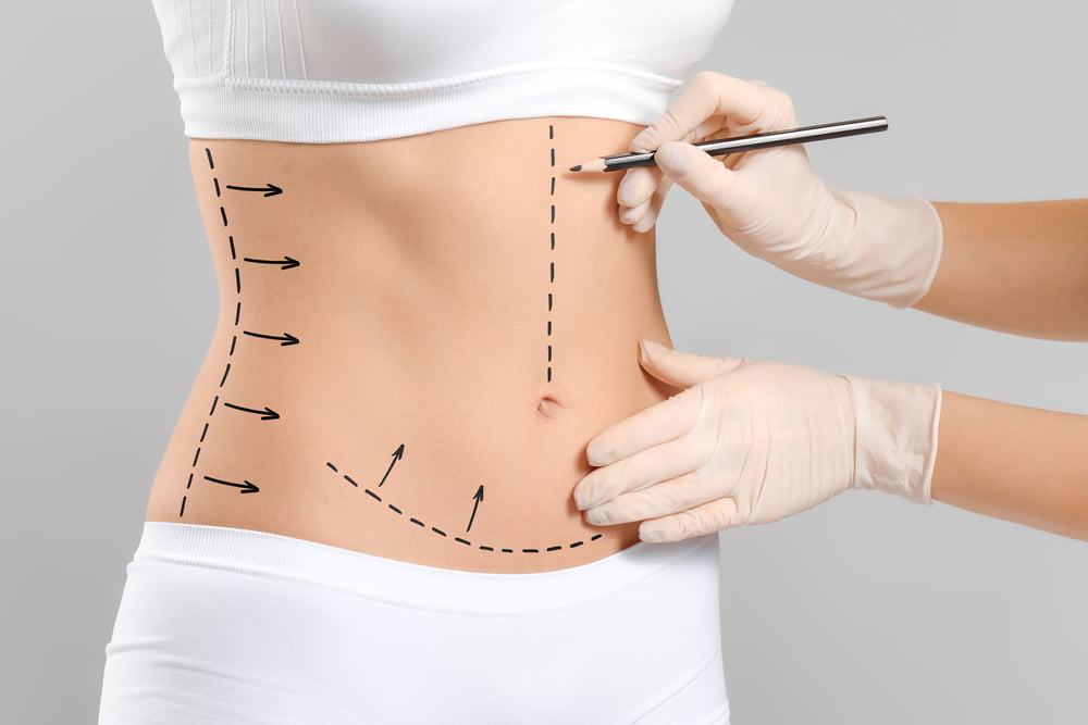 Chirurgien plasticien appliquant des marques sur le corps d'une femme